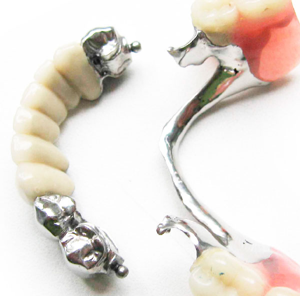 Removable partial dentures